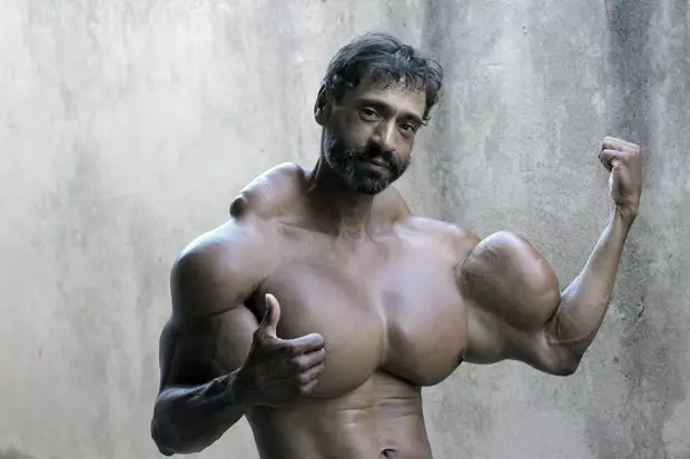 Bodybuilder Risks Life By Injecting Oil Into His Arms