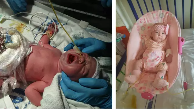 Baby Born With Her Intestines Outside Her Body Set To Celebrate Her First Birthday 