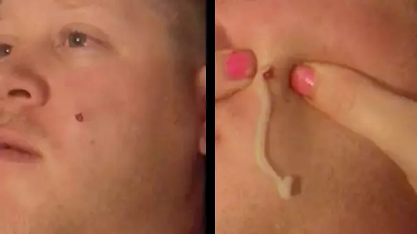 Wife Pops Huge Spot On Her Husband With Disgusting Results