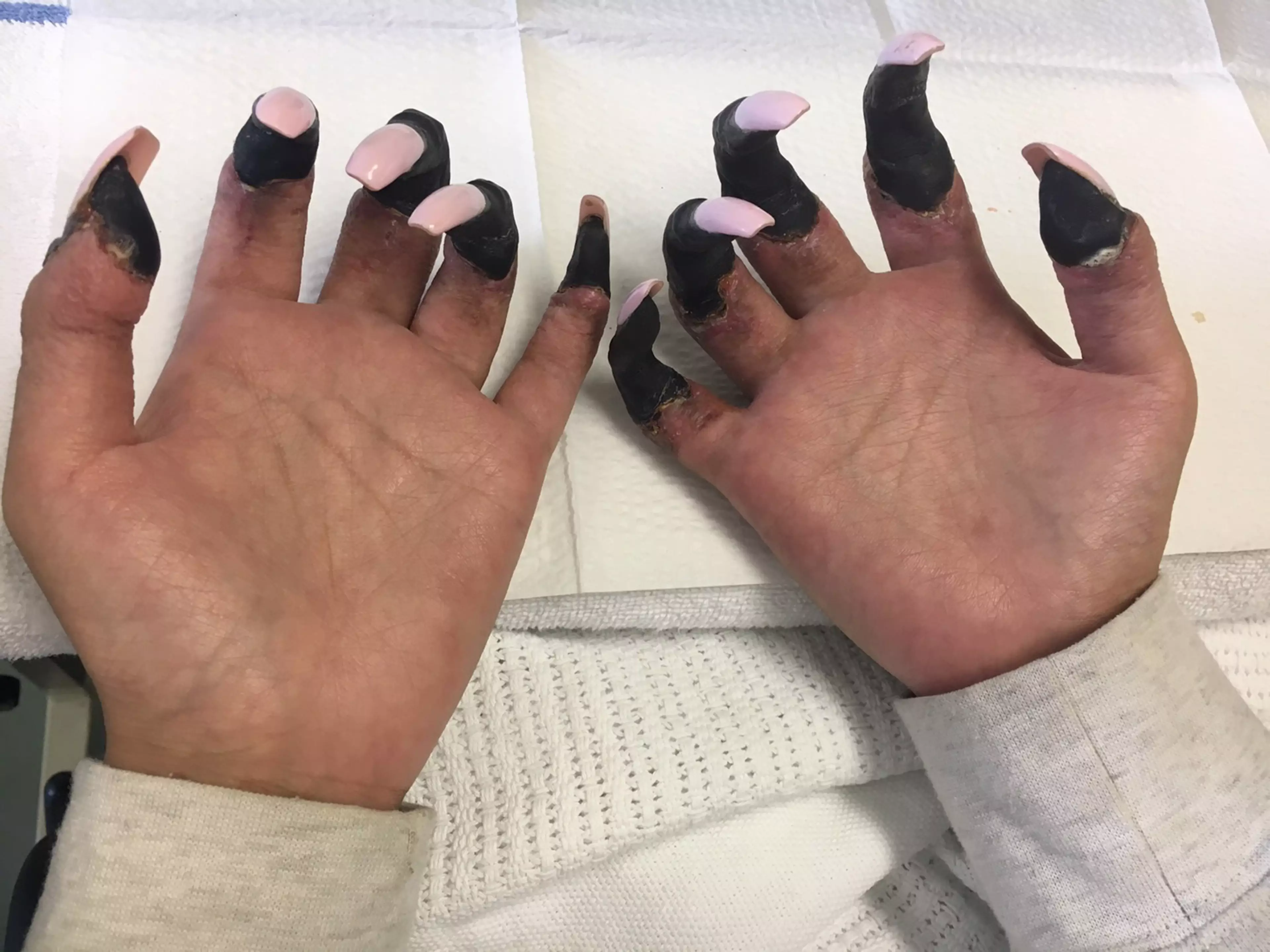 Juttima's fingers turned black (