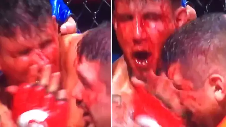 Frank Mir Left In A Bloody Mess After Losing Gumshield, Teeth And The Fight