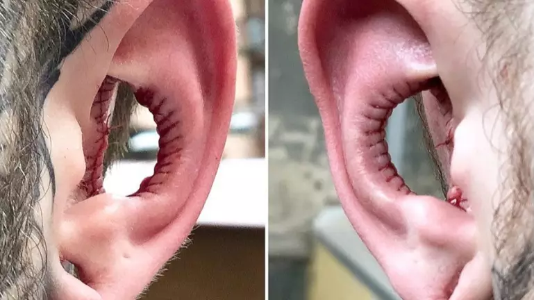 Man Has Inside Of His Ears Taken Out In New Body Modification Trend