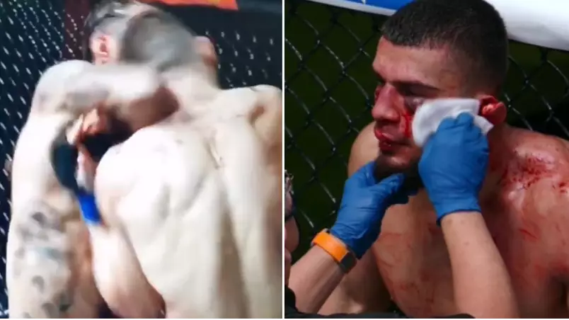 MMA Fighter's Ear Almost Ripped Off After Gruesome Injury On UFC Debut
