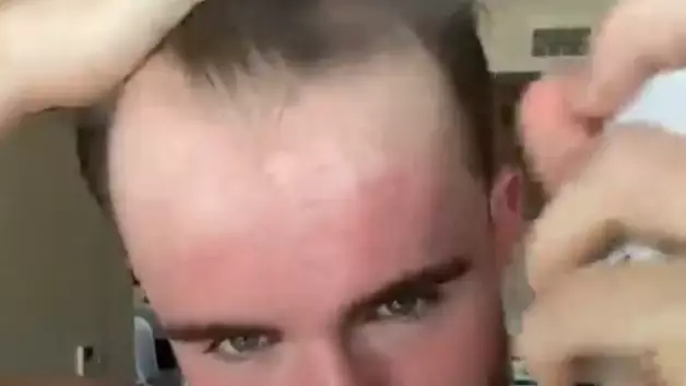 TikToker Shows His Hack To Hide Receding Hairline