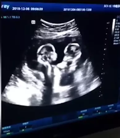 According to reports, the twin girls were both born healthy.
