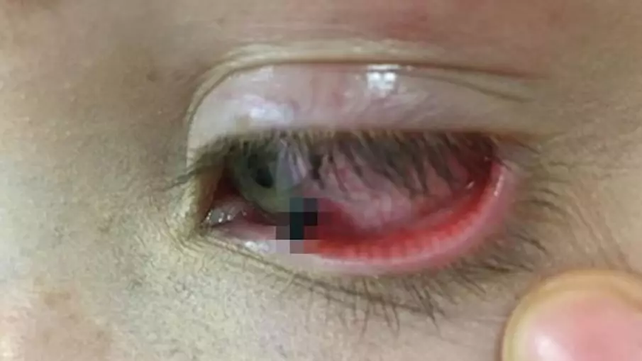 Teen Girl Gets Lead Stuck In Her Eye After Classmate Throws Pencil