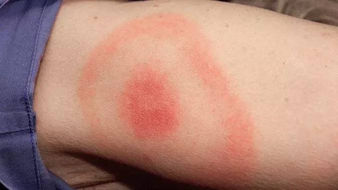 People With 'Bullseye' Rash Should Be Immediately Treated For Lyme Disease  