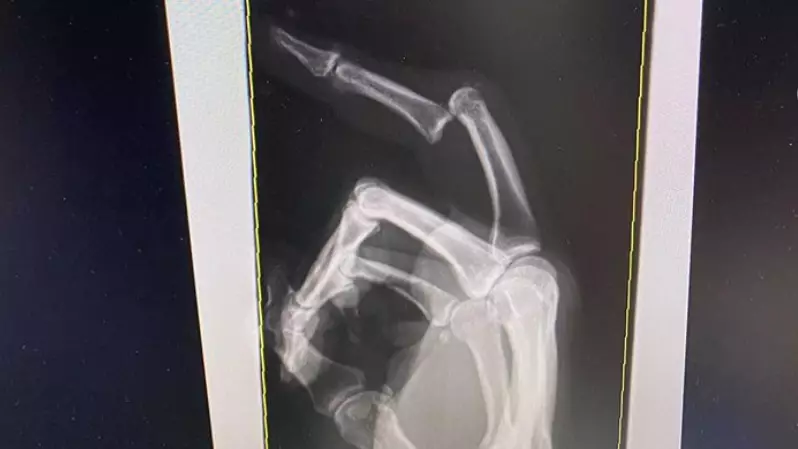 Andrew Fifita Has Posted A Picture Of His Dislocated Finger On Social Media