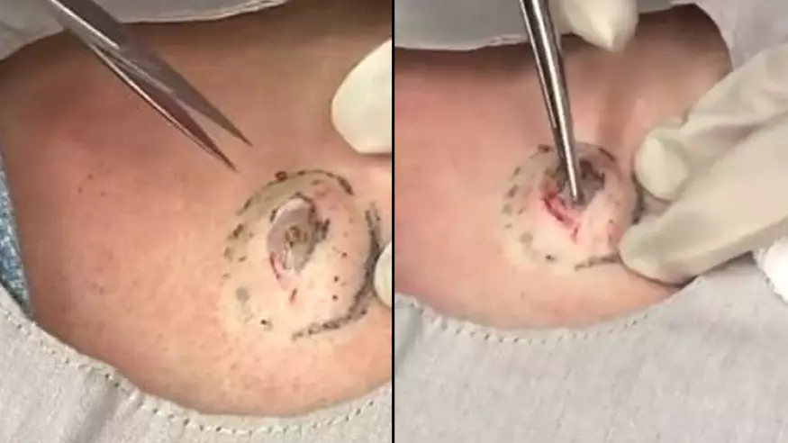 Dr Pimpled Popper Squeezes Out Something Disgusting From A Cyst