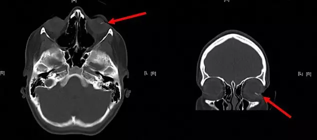 A CT scan shows where the lead was stuck.