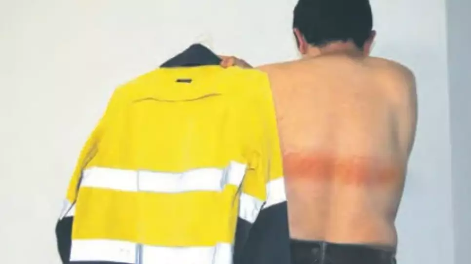 Workman Gets First-Degree Burns From Reflective Strip On His High-Vis Jacket