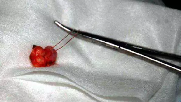 Doctors Remove Molar Tooth Growing Inside 13-Year-Old's Testicle 