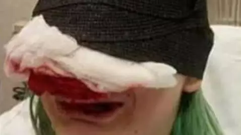 BLM Protestor Sues Police After Her Nose Was Ripped Off When She Was Shot In The Face