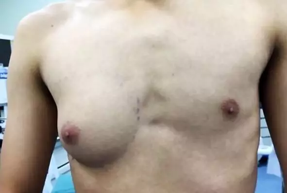 Guy develops A-cup breast