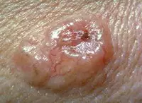 Basal Cell (non-melanoma) skin cancer. (