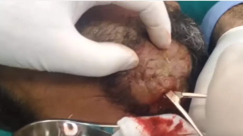 Watch This Man Getting An Abscess Popped If You Don't Want To Eat For A Year