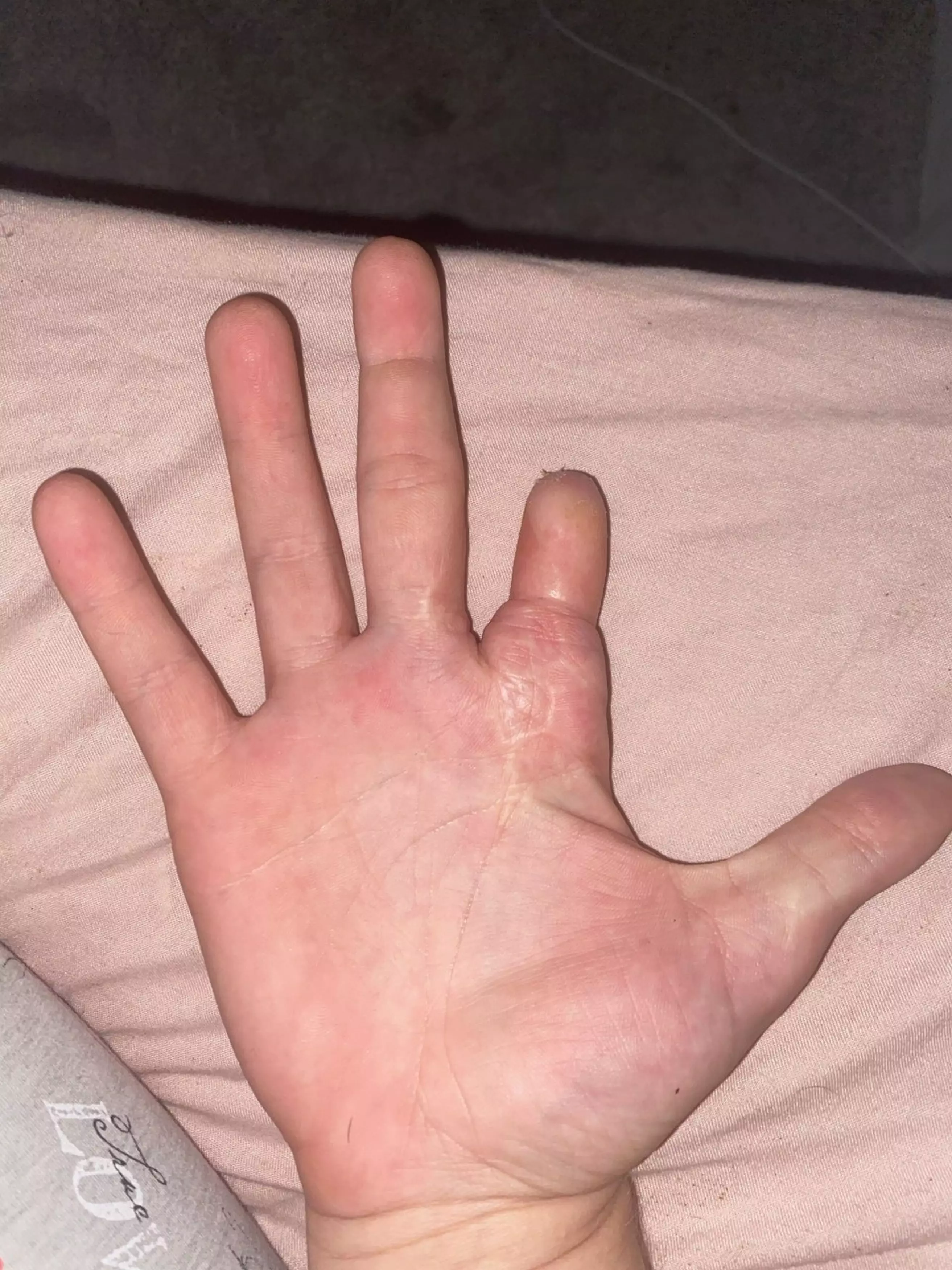 Sophie Collins lost her right index finger (