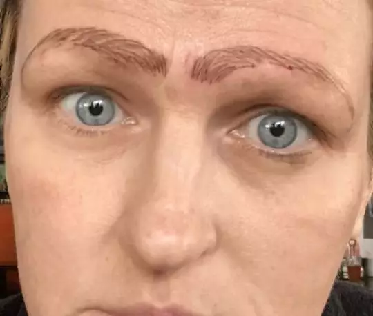 The procedure left her with four brows.