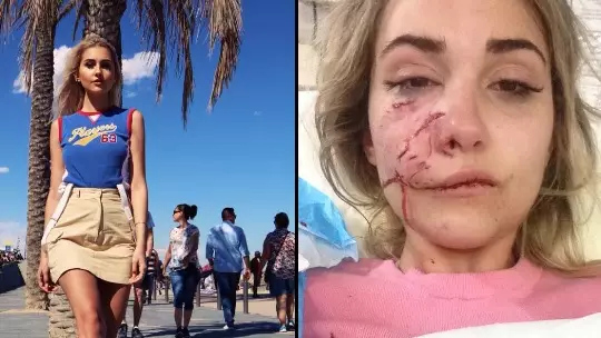Model Needed Plastic Surgery After Brutal Dog Attack 