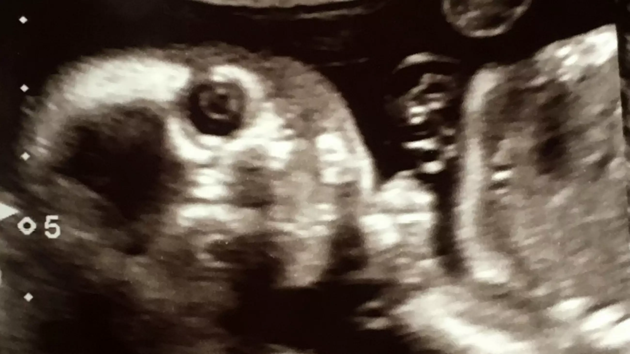 Mum Shocked As Baby Stares At Camera In 'Creepy' 20-Week Scan