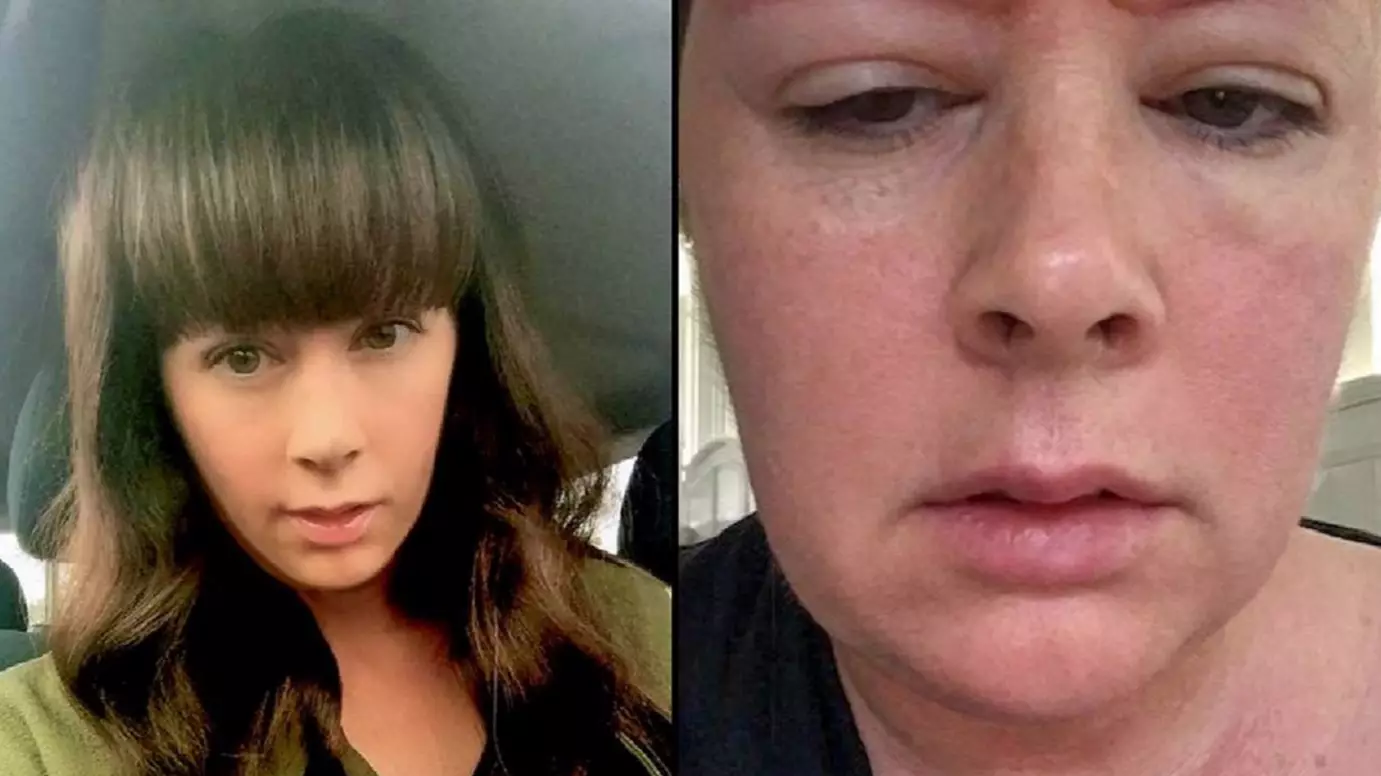 Woman Shares Pictures Of Her Eyebrows After 'Botched Tattoo Treatment'
