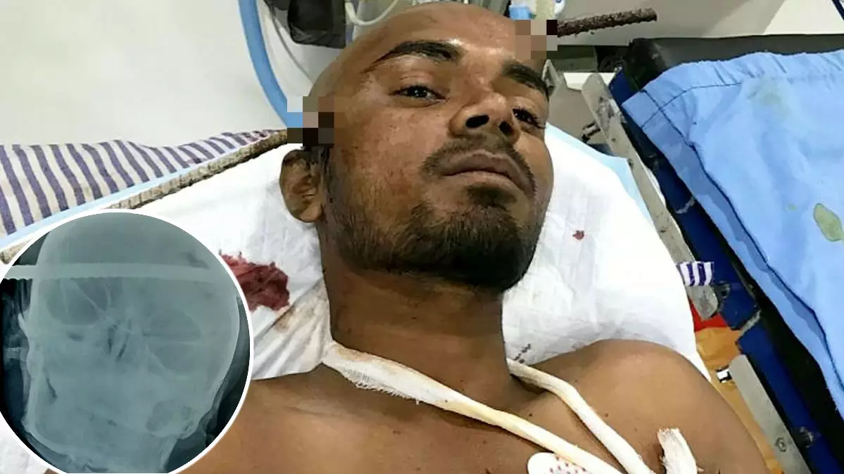 Gruesome Pictures Show Construction Worker Undergoing Surgery To Remove Iron Rod That Pierced His Head
