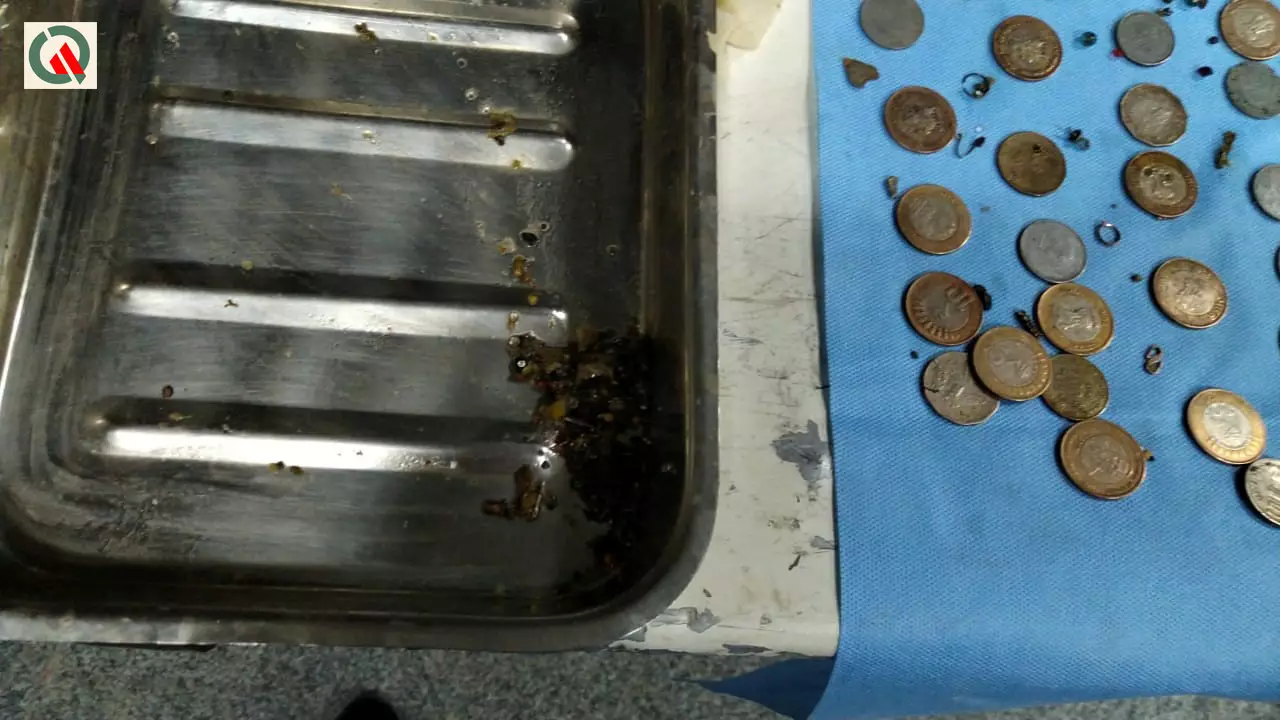 90 coins were removed from the woman's stomach.