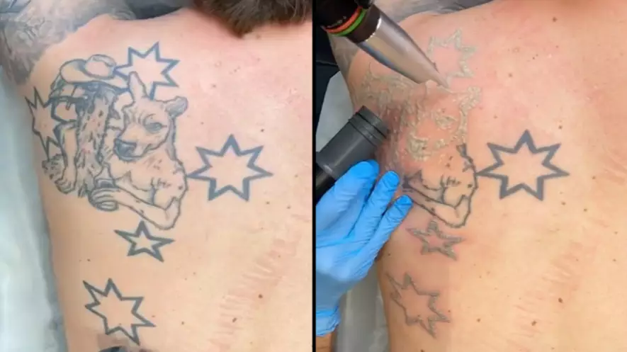 Bloke Branded 'Un-Australian' For Getting Southern Cross Tattoo Removed