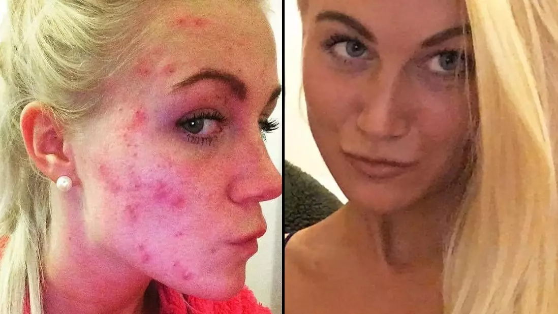 Woman Bullied Because Of Her Severe Acne Finds Cheap 'Cure'