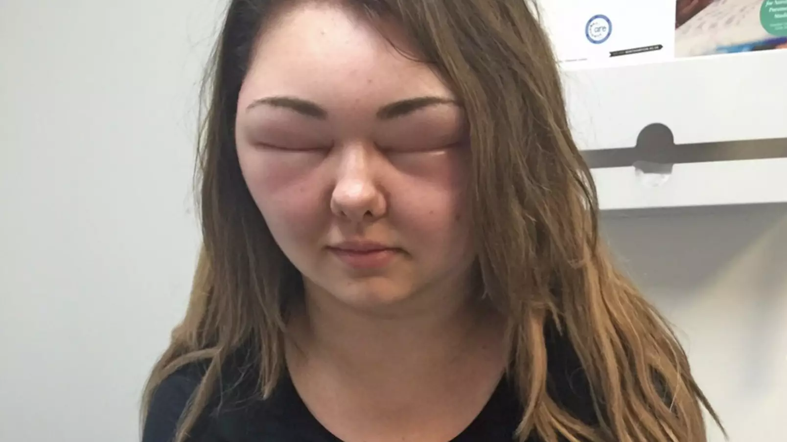 Woman Blinded After Allergic Reaction To Hair Dye Causes Head To Swell Like 'Alien'
