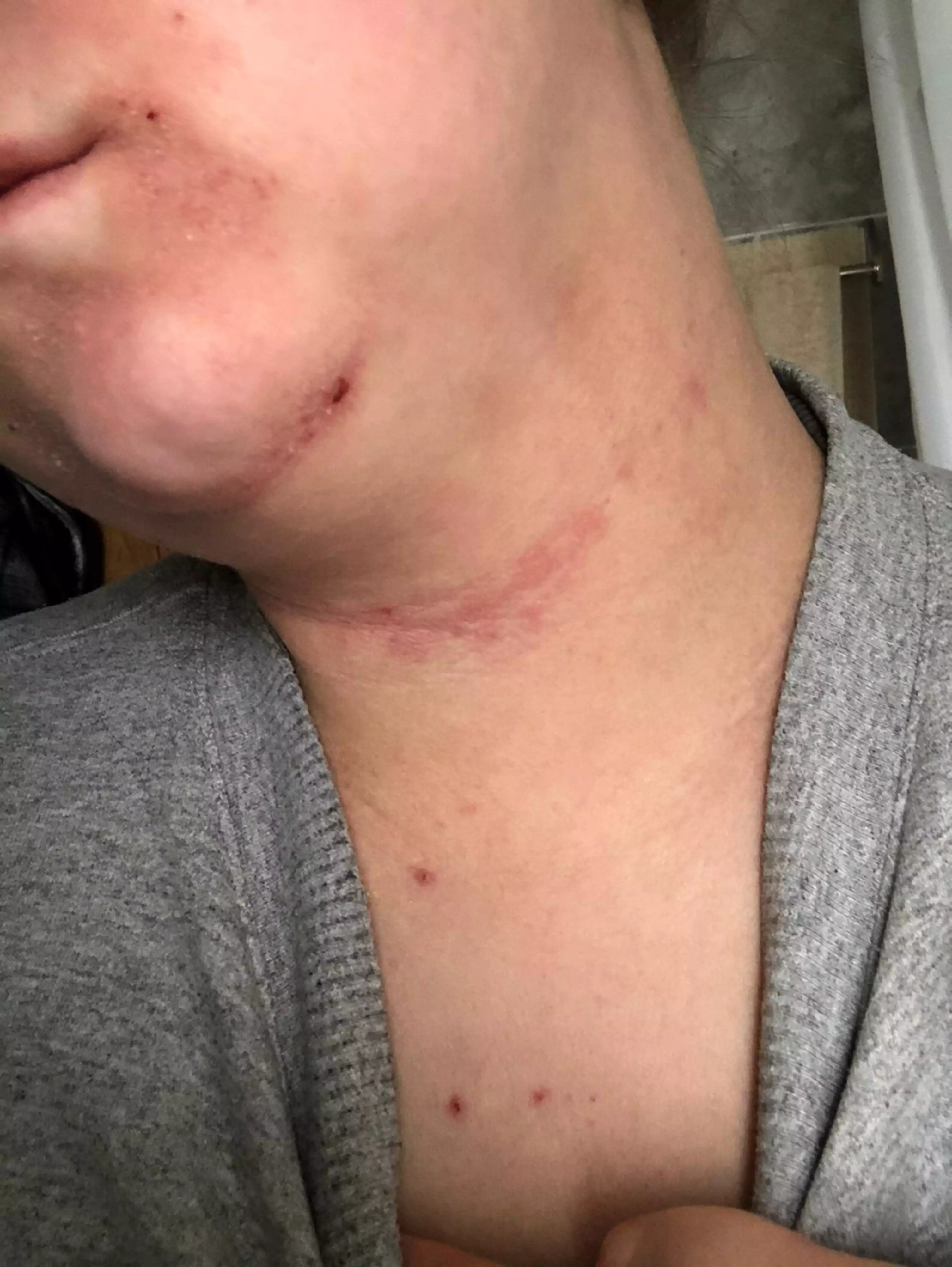 Megan said her eczema has been seriously affecting her confidence (