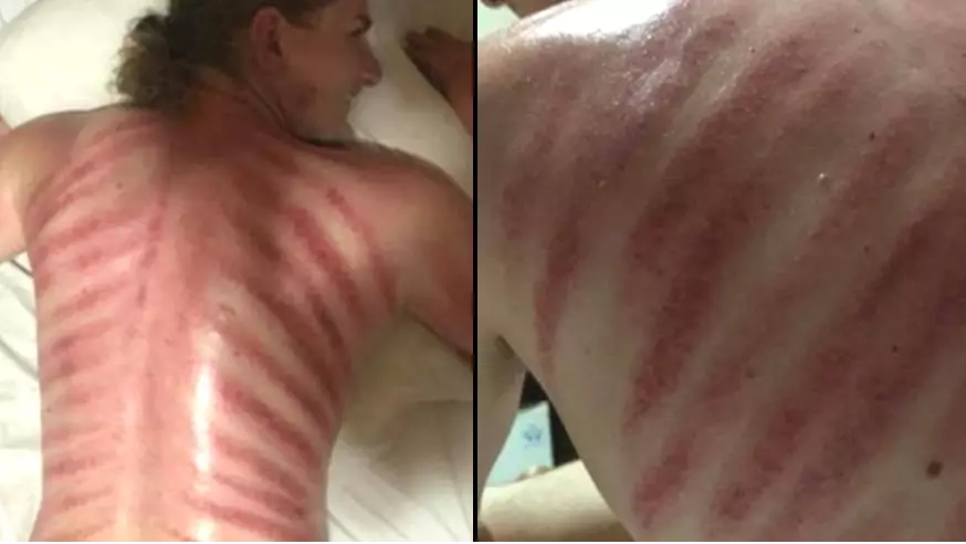 Tourist Discovers Red Raw Marks On His Back After 'Red Dragon' Massage