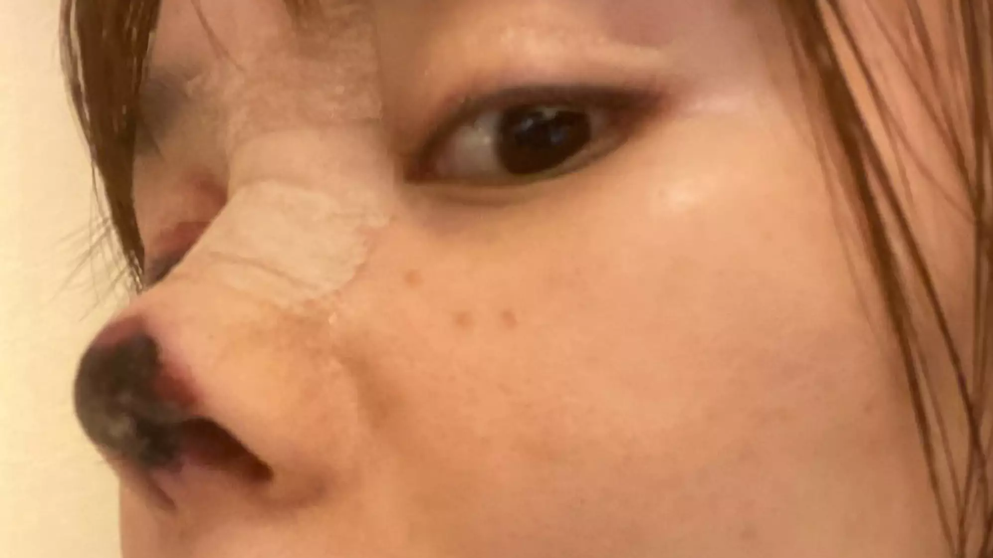 Woman Left With Black Rotting Nose After Operation Goes Wrong 