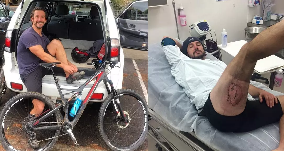 Mountain Biker Suffers Third-Degree Burns After iPhone Exploded In His Pocket