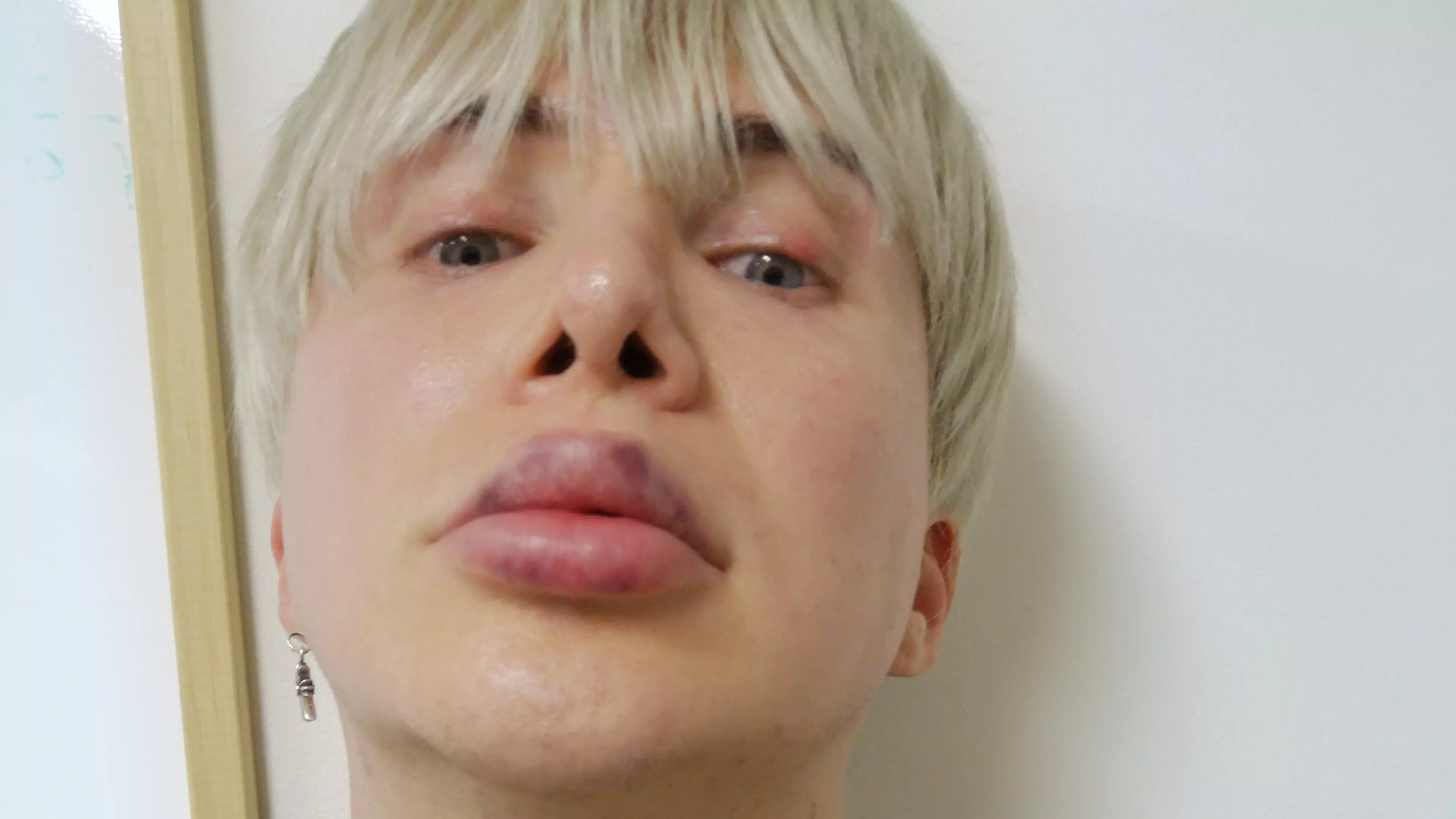 British K-Pop Star Unable To Sing Properly Because Of Cosmetic Lip Treatments
