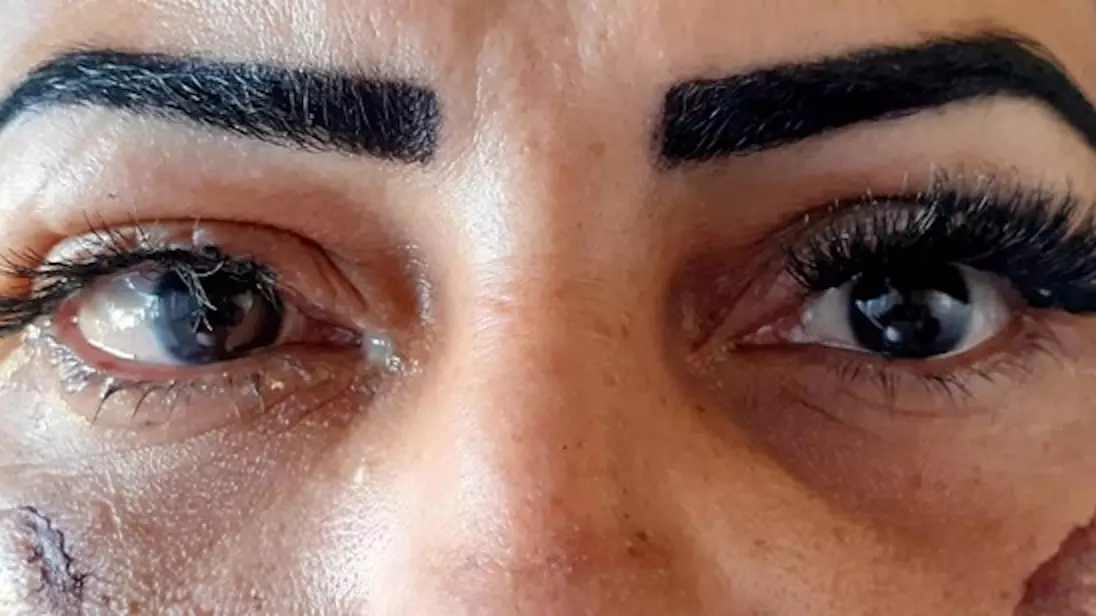 Woman Claims She Was Blinded In One Eye After False Eyelash Glue Accident