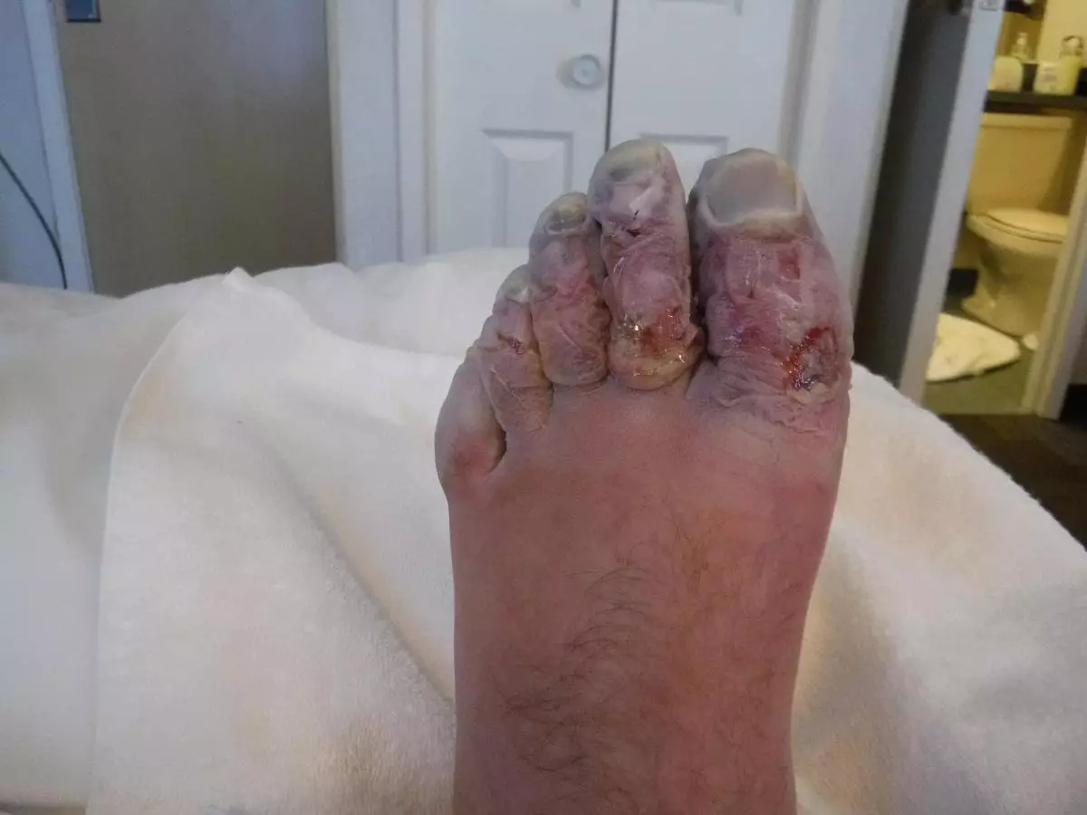 He suffered third-degree frostbite and had three toes amputated.