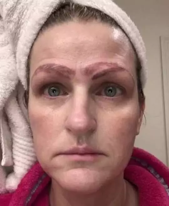 She was left with four eyebrows and is now undergoing expensive treatment to have them removed.
