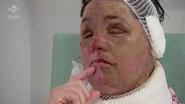 ​Acid Attack Victim Is Still Traumatised And Finds It Hard To Look In The Mirror
