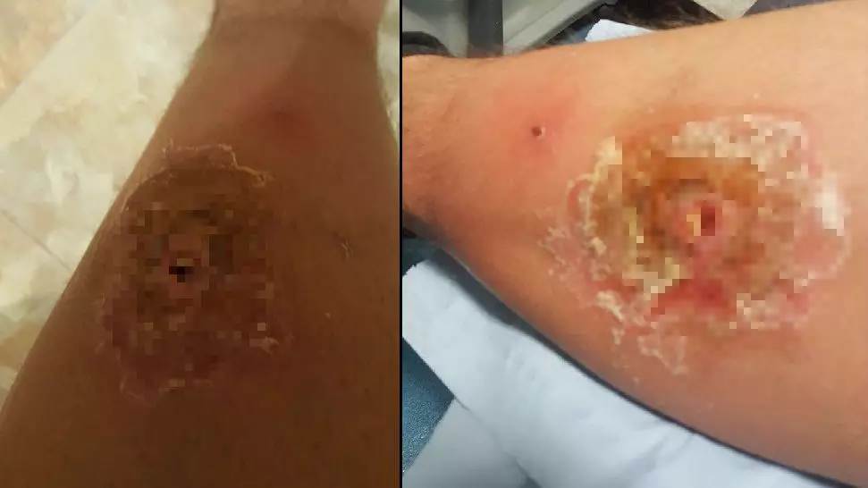 Man Left With Hole In His Leg After Britain's Most Venomous Spider Bit Him