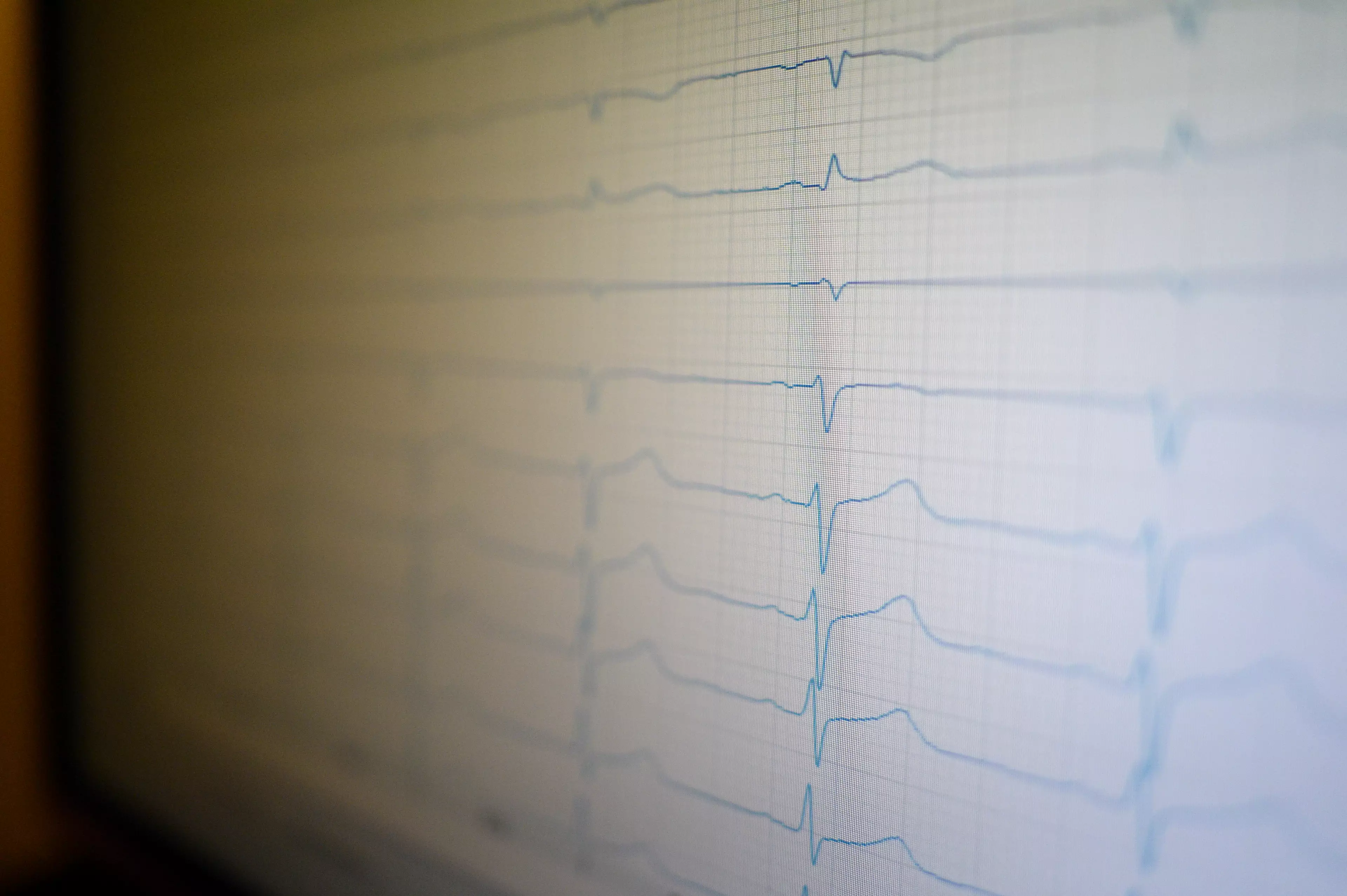 An ECG machine monitoring someone's heart.