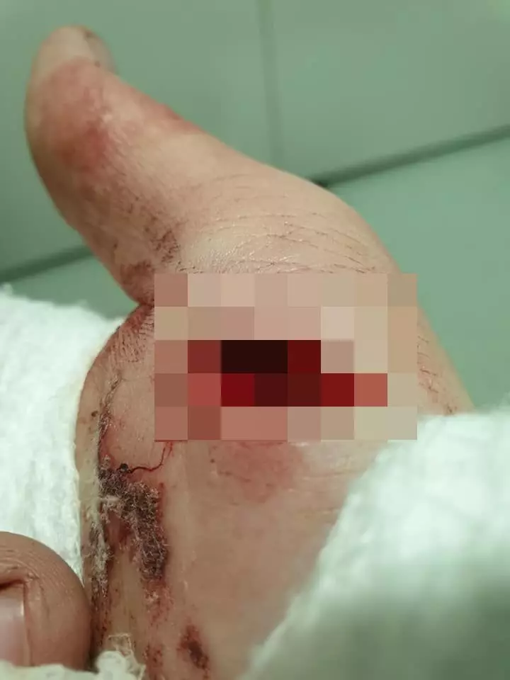 The dad-of-two was out walking his dog when he cut his hand open.