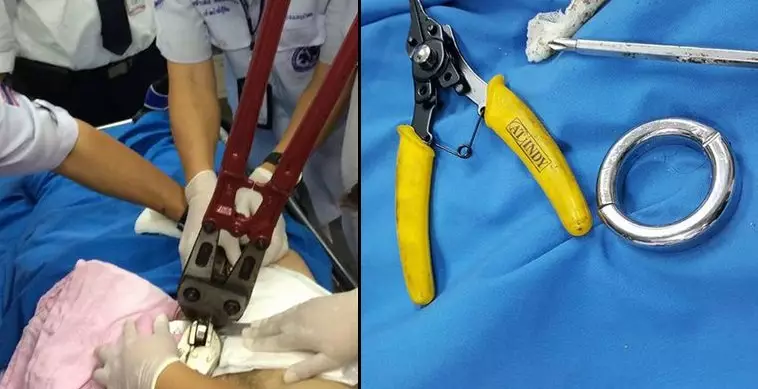 Doctors Had To Use Bolt Cutters To Remove A Metal Cock Ring From Man's Penis