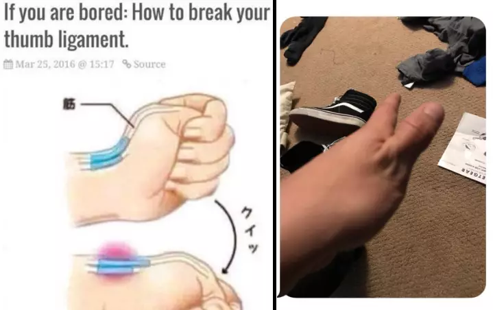 People Are Dislocating Their Thumbs Because A Meme Showed Them How