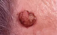 Melanoma skin cancer. (