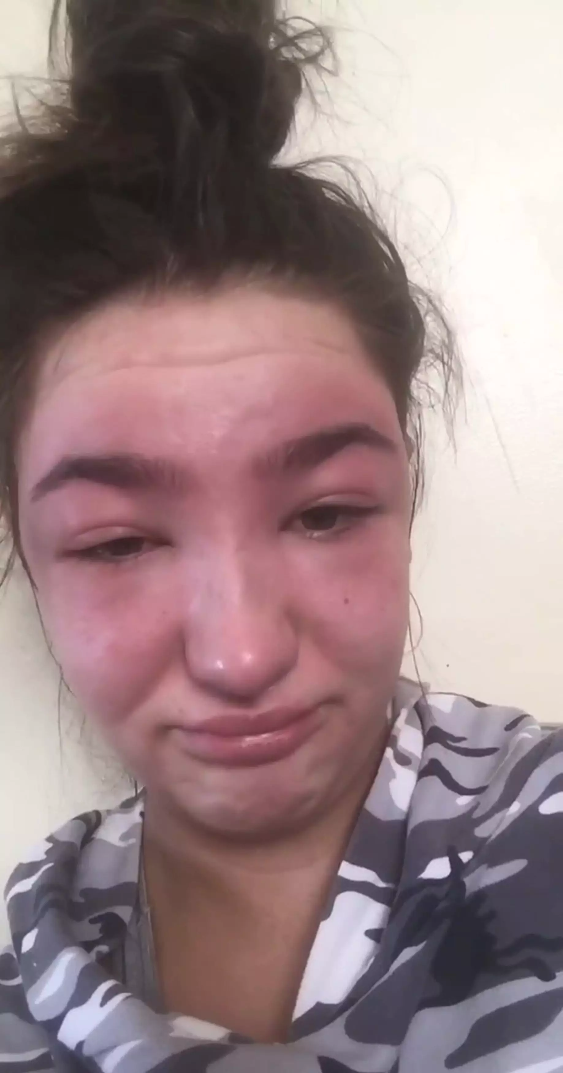 Stephanie had an allergic reaction to eyebrow tints (