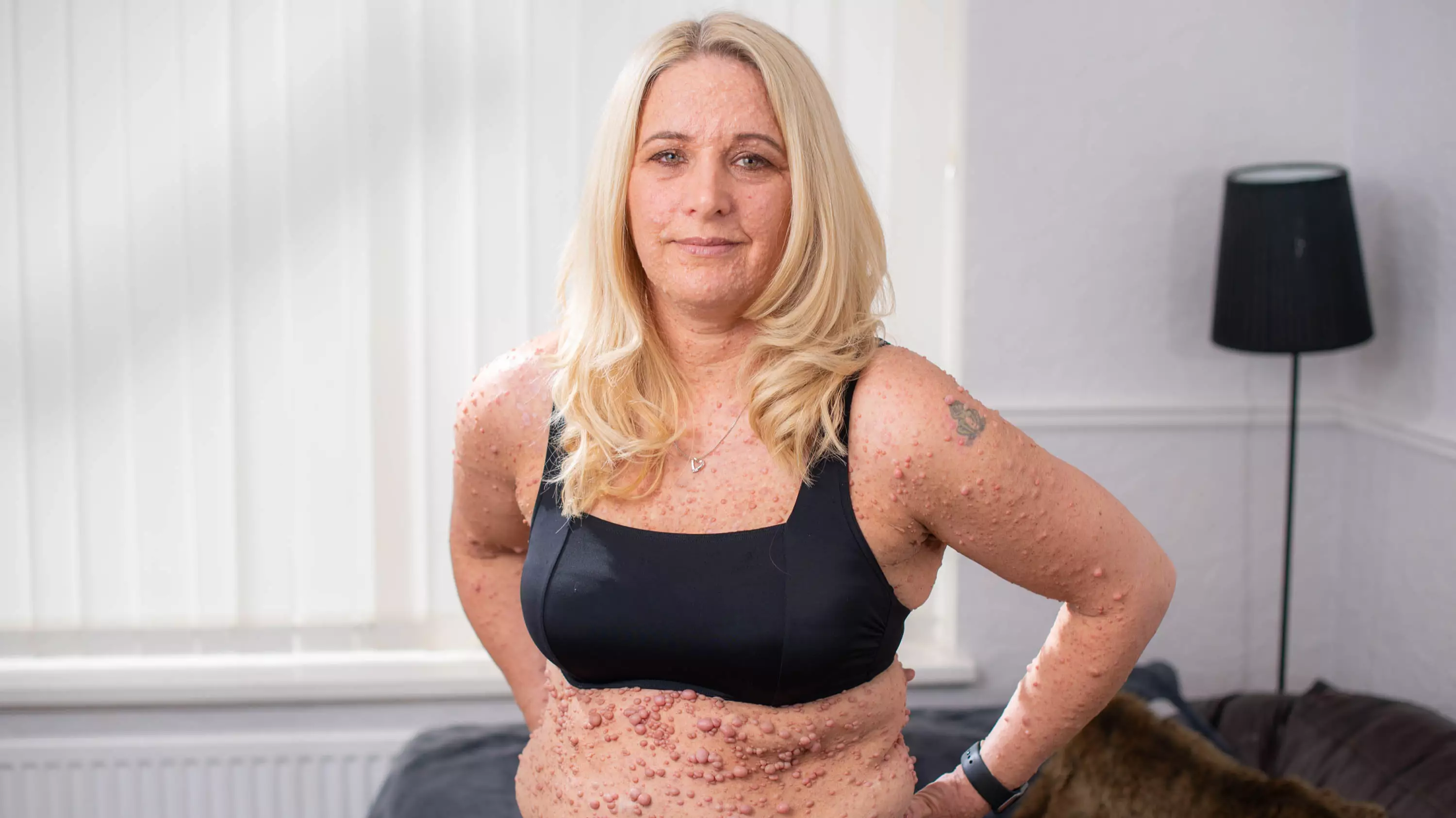 Mum With Rare Skin Condition Finally Finds Confidence To Wear A Bikini In Public