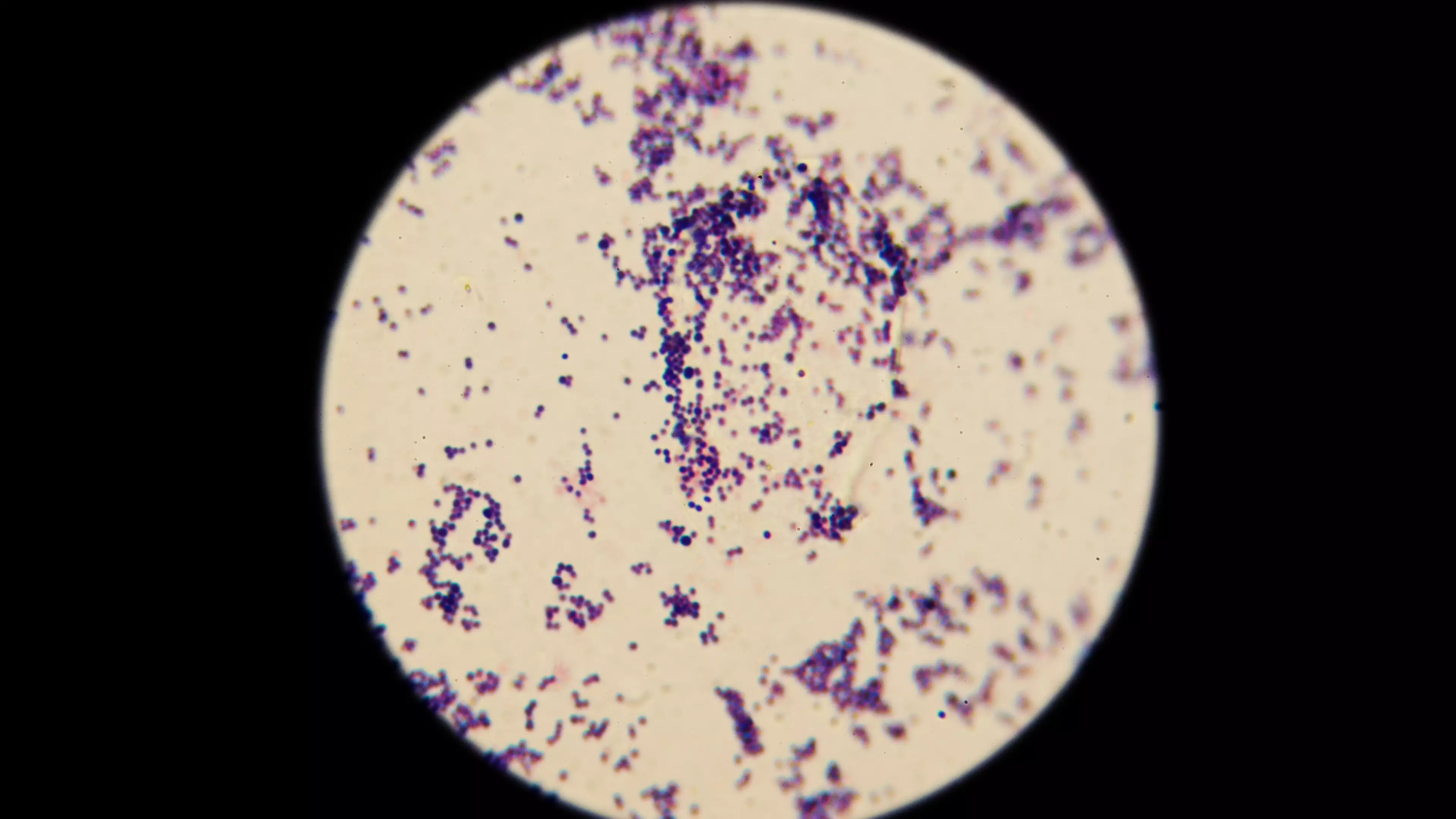 Man Returns From South East Asia with Antibiotic Resistant 'Super Gonorrhoea'