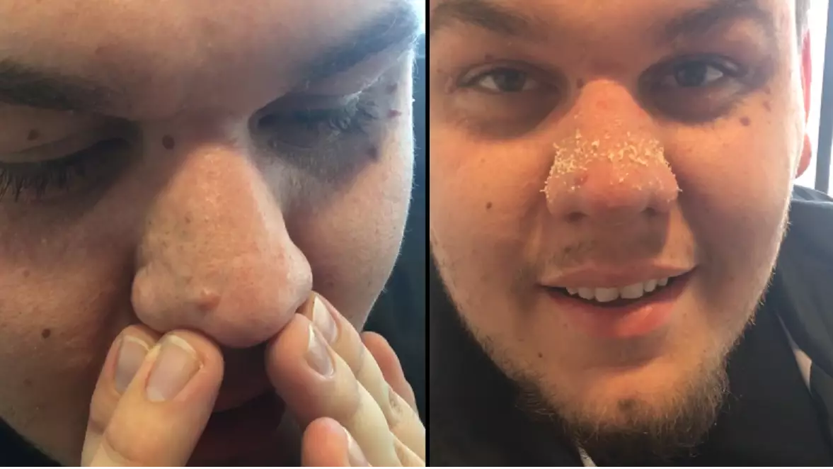 ​This Man’s Blackhead Removal Technique Is A Complete And Utter Gamechanger  