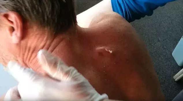 This Video Of A Ping Pong Ball Sized Pimple Being Popped Is Gross